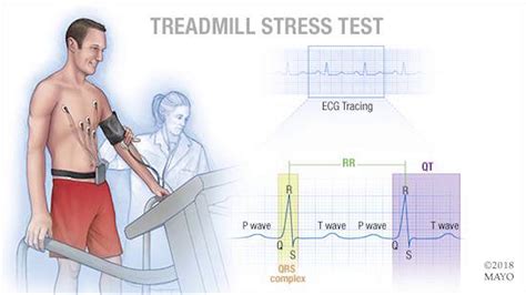 cardiac stress test results